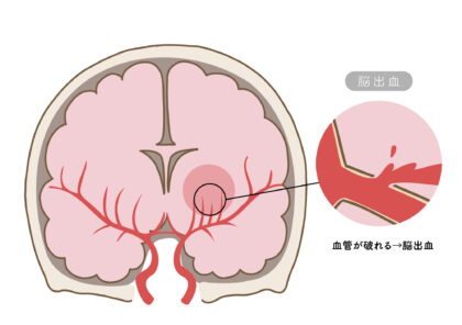 脳出血