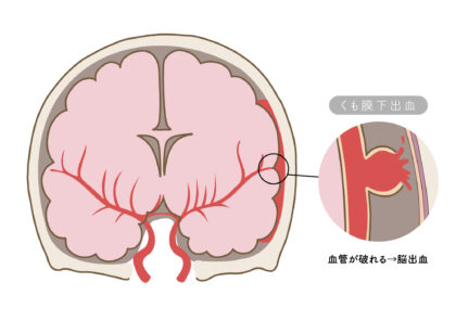くも膜下出血（SAH）
