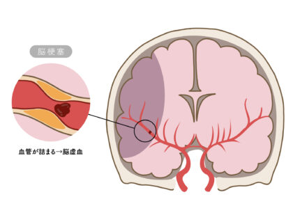 脳梗塞